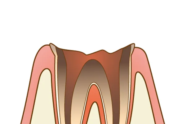 C4の虫歯